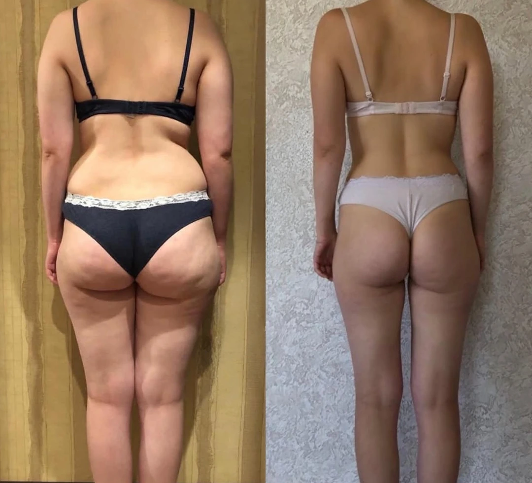Avaliação de cliente CelluLipo