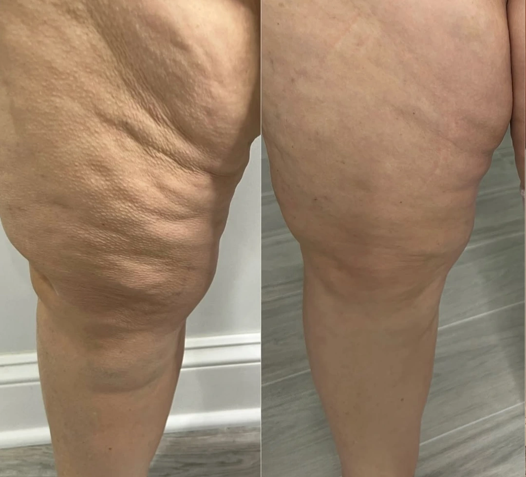 Avaliação de cliente CelluLipo